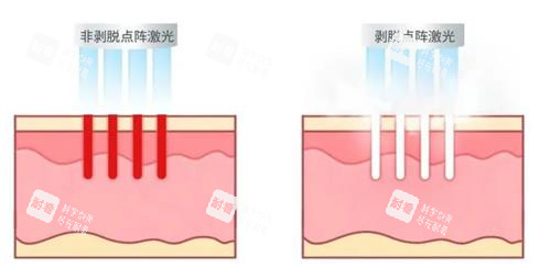 不同类型的点阵激光 不同类型的点阵激光
