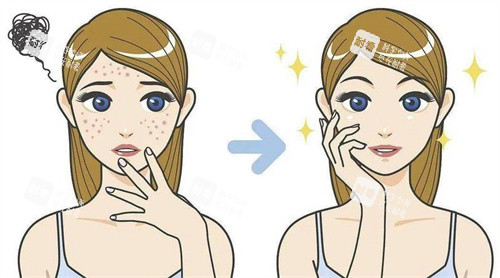 去痘印卡通图 去痘印卡通图