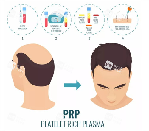 脱发PRP注射治疗前后对比图