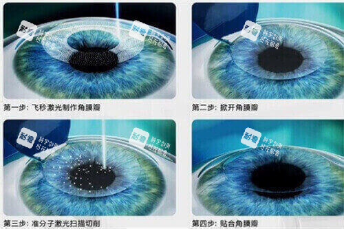 近视矫正手术过程示意图