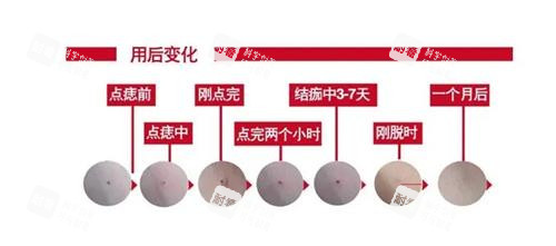 激光去痣后的成效 激光去痣后的成效