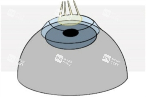 Refractive-Surgery-Techniques-1024x493_副本