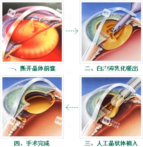 白内障手术过程图