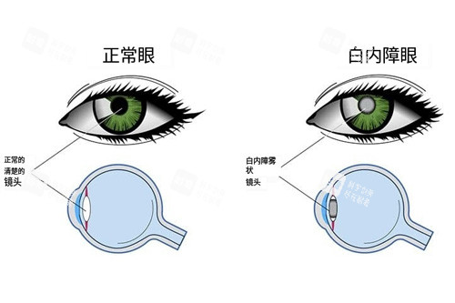 患白内障前后成像对比图 患白内障前后成像对比图