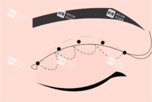 埋线双眼皮 埋线双眼皮