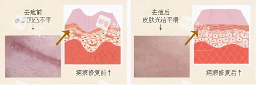 激光祛疤卡通示意图 激光祛疤卡通示意图
