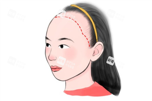 女型发际线种植卡通 女型发际线种植卡通
