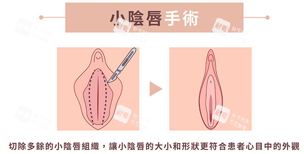小阴唇整形手术前后照片 小阴唇整形手术前后照片