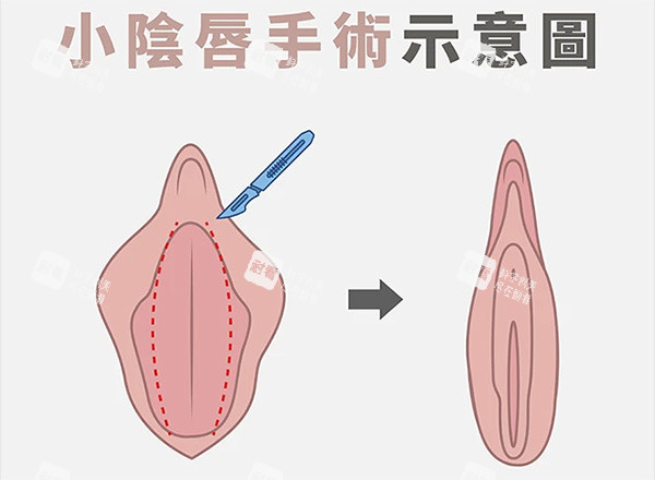 小阴唇整形前后对比 小阴唇整形前后对比