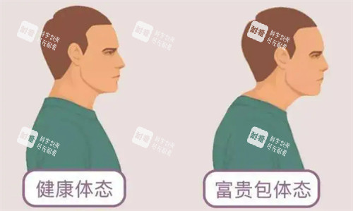 健康体态和富贵包体态对比