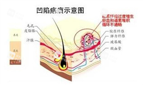 凹陷疤痕