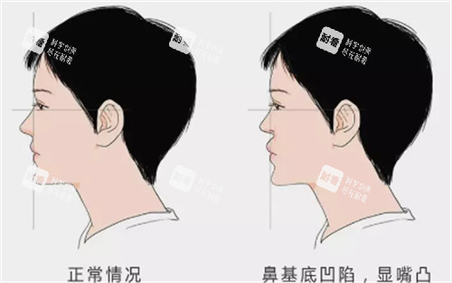 鼻基底凹陷对面部的影响图解
