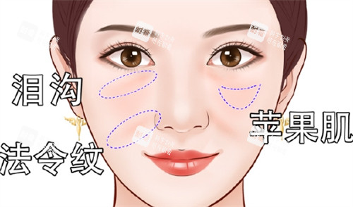 面部凹陷之后所呈现的面部状态