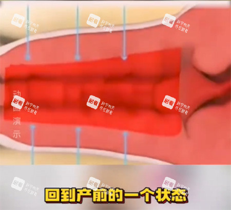 女性私密收紧针照片