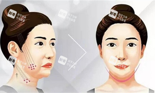 埋线提升卡通图.jpg