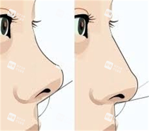 膨体隆鼻前后对比.jpg