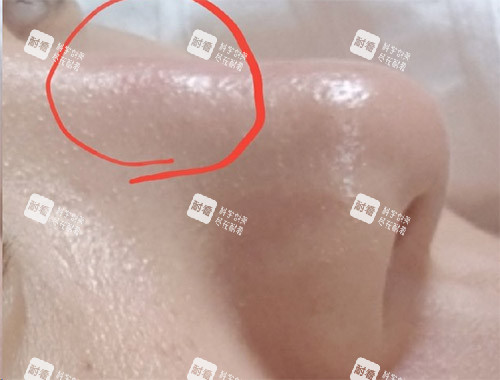 隆鼻炎症透光图片.jpg