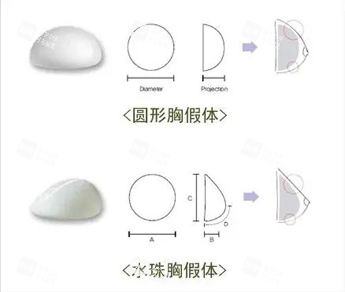 丰胸手术曼托圆形及水滴形假体植入示意图.jpg 丰胸手术曼托圆形及水滴形假体植入示意图.jpg
