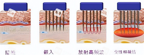 黄金微针操作过程.jpg