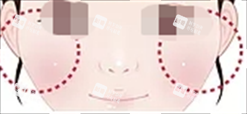 玻尿酸填充眼下填充.png