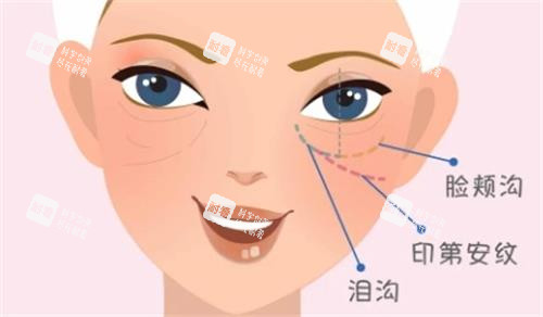泪沟填充图.png 泪沟填充图.png