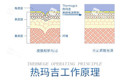 热玛吉工作示意图.jpg
