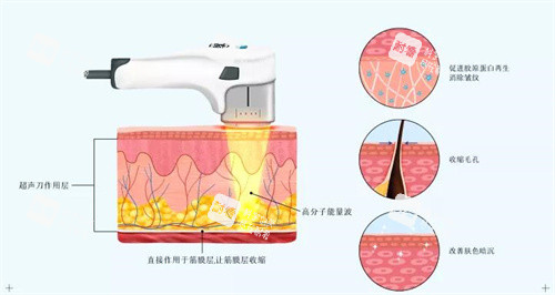 超声炮原理.jpg