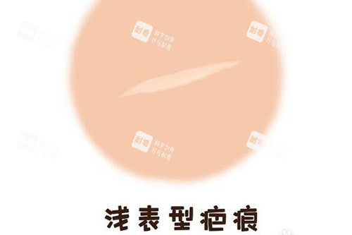 浅表型疤痕修复改善.jpg 浅表型疤痕修复改善.jpg