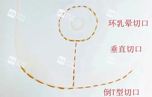 丰胸手术胸部下垂提升倒T字法.jpg