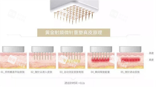 黄金微针原理.jpg