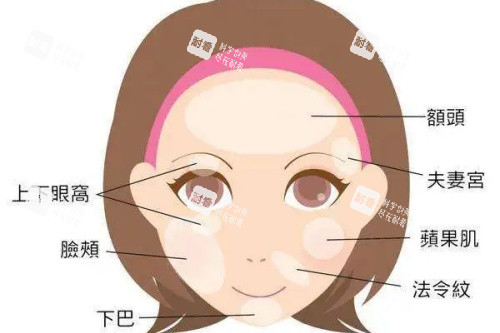 面部可以脂肪填充的部位卡通图.jpg