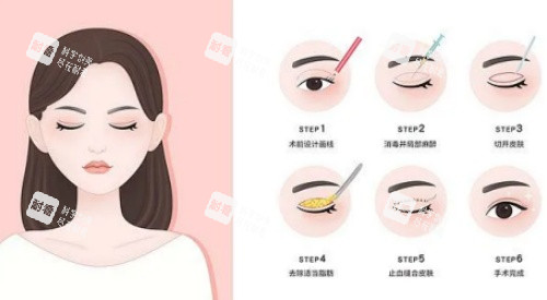 拉双眼皮手术示意图.jpg