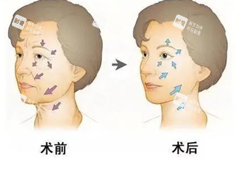 面部抗衰前后对比卡通示意图.jpg
