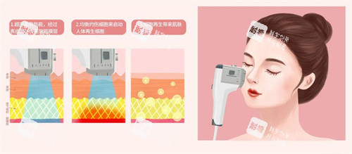 超声炮.jpg