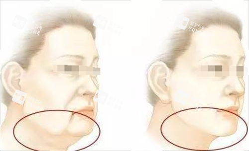 微拉美面部提升动画前后对比图.png