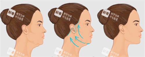 面部提升改善皮肤状态.jpg