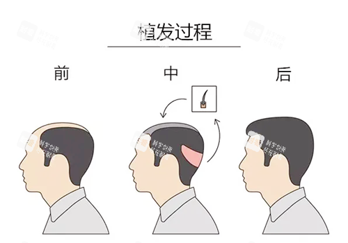 植发过程图示.png 植发过程图示.png
