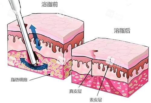 射频溶脂术皮肤层.jpg 射频溶脂术皮肤层.jpg