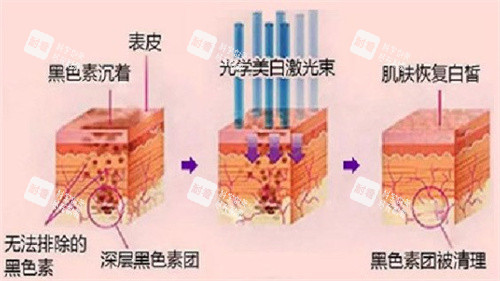 光子嫩肤原理.jpg