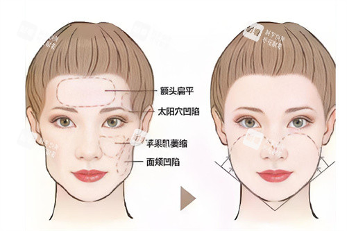 面部轮廓填充前后对比.jpg