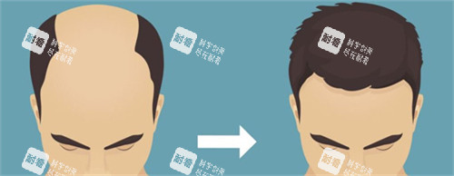 植发手术前后对比.jpg 植发手术前后对比.jpg
