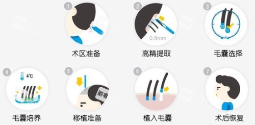 植发过程图解.JPG 植发过程图解.JPG