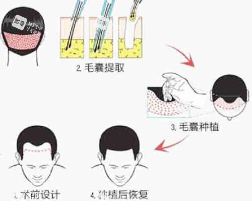 植发过程图解详细.jpg 植发过程图解详细.jpg
