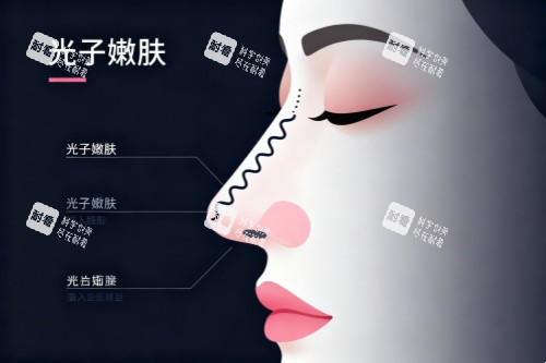 面部做光子嫩肤卡通图.jpg