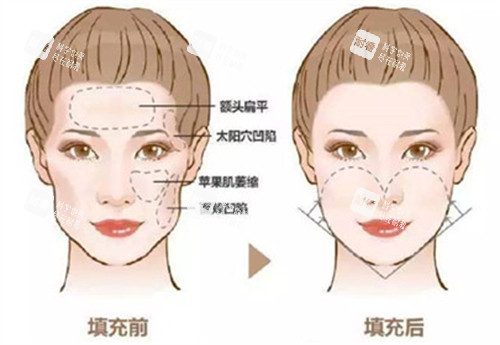 自体脂肪填充前后对比图.jpg