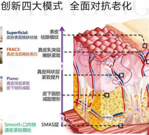 fotona4d欧洲之星不同模式对应层次.jpg