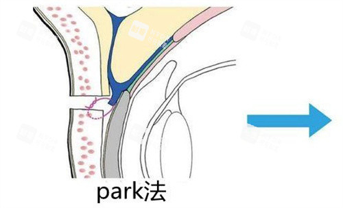 Park法双眼皮.jpg