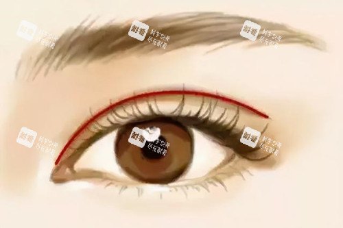 开扇形双眼皮.jpg