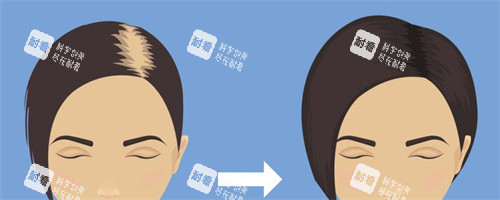女性毛发移植对比动画图.jpg