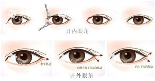 开眼角手术过程图.jpg